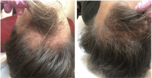 Hair Loss in Women and Men: Common Causes and Minimally-Invasive Treatment Options