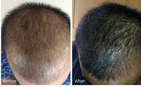 Hair Loss in Women and Men: Common Causes and Minimally-Invasive Treatment Options