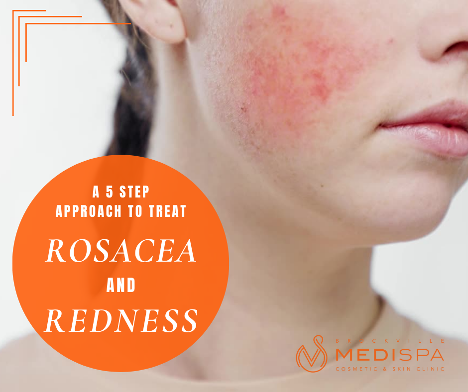5-Step Approach to Rosacea and Redness Reduction
